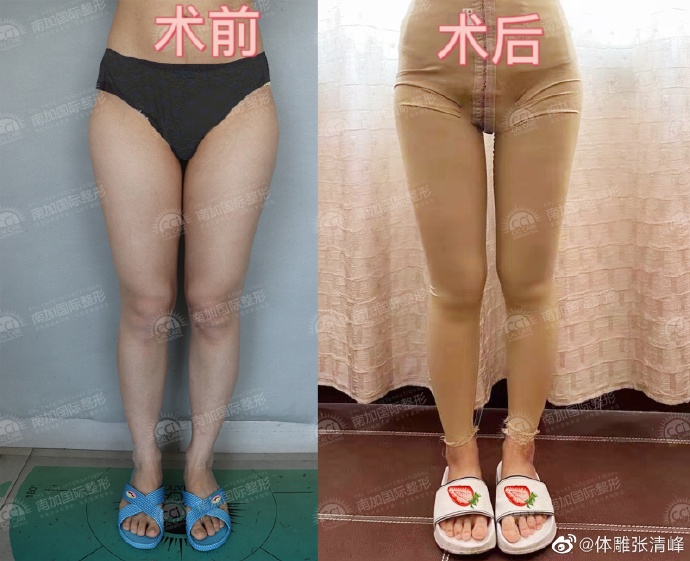 张清峰大腿吸脂案例