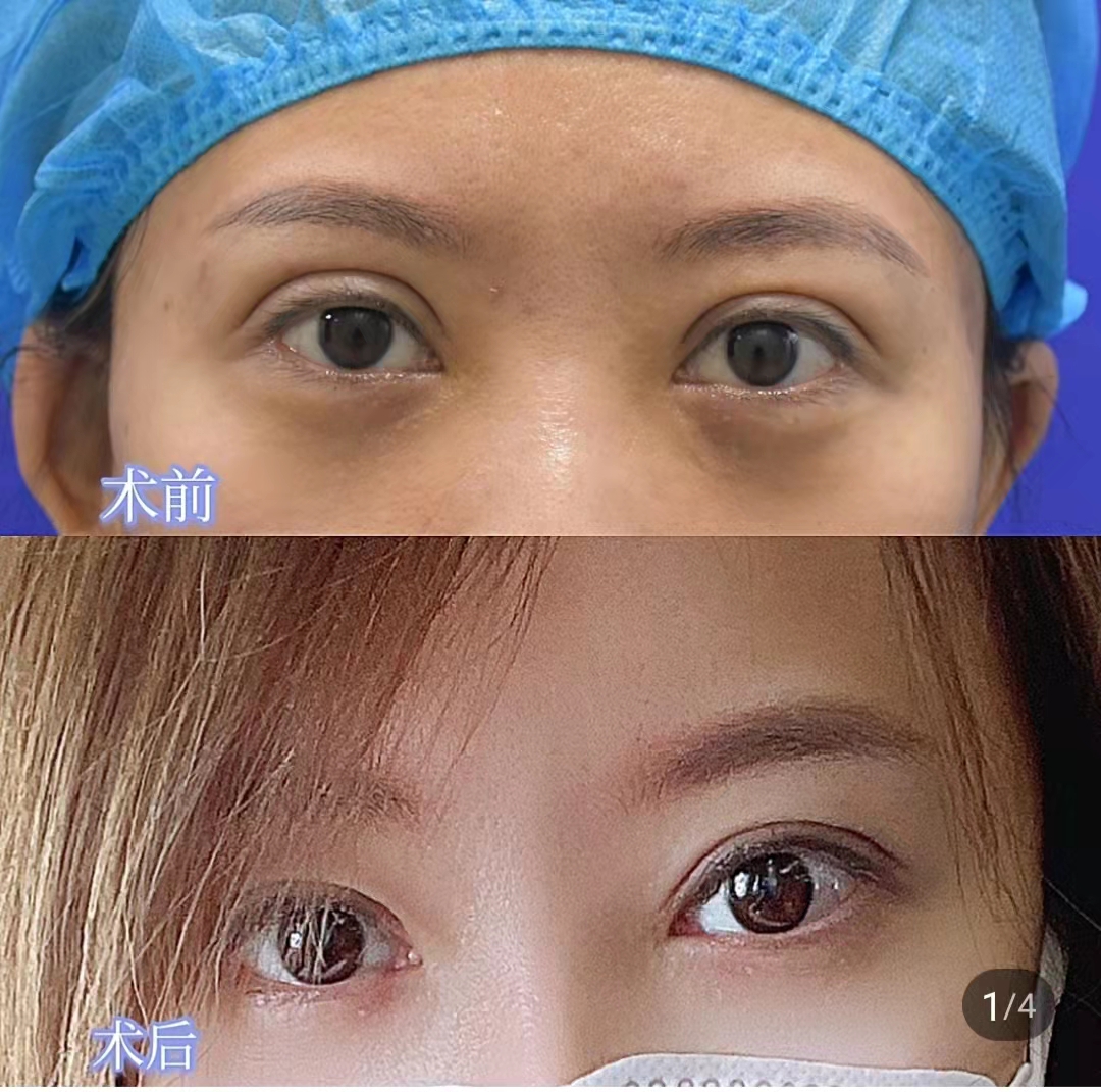 2021年国内双眼皮修复最厉害的有哪些？