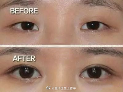 王香平做双眼皮技术好吗？多少钱？