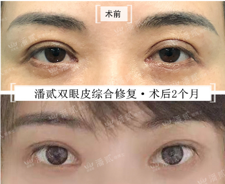 广州潘贰双眼皮修复技术怎么样？