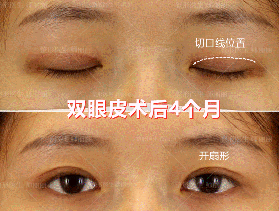 中国修复双眼皮开扇哪个医生做的好？
