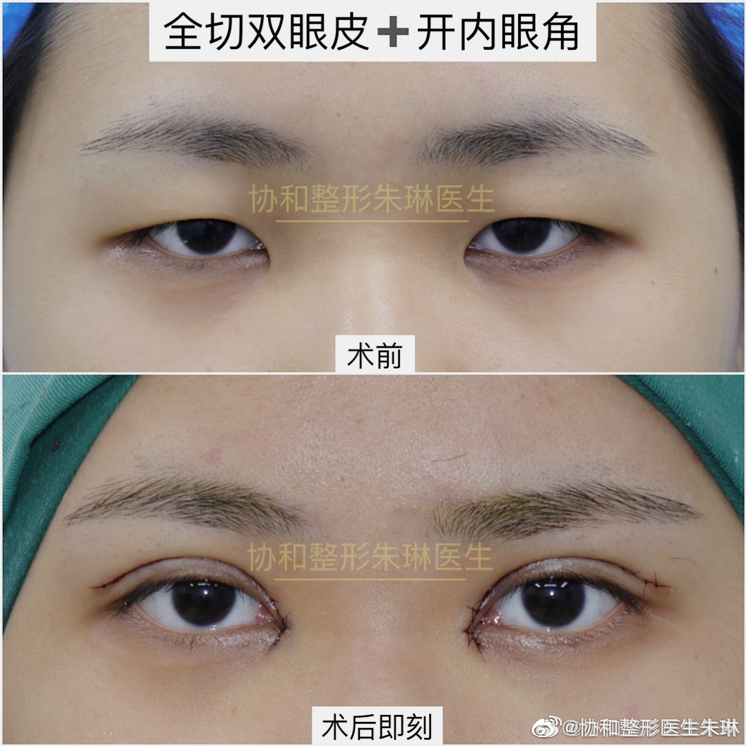 北京协和知名双眼皮医生朱琳割双眼皮怎么样？
