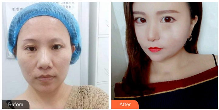 郑州双眼皮修复哪个医院最好？