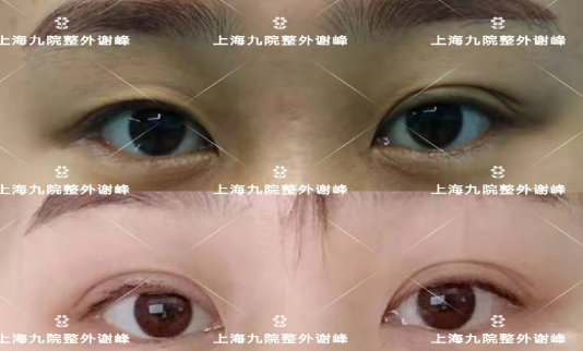 上海九院谁双眼皮修复做得好？