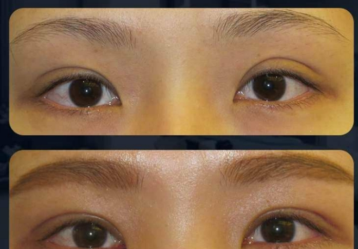 武汉双眼皮修复厉害的医生有哪些？