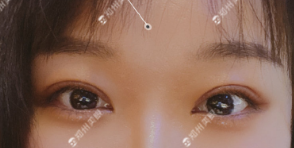 郑州修复眼睛最好的医生是谁？