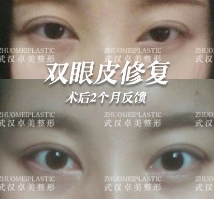 武汉双眼皮修复哪里做的比较好？