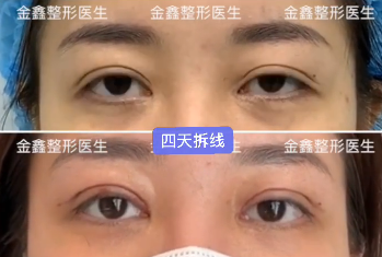 深圳有哪些做双眼皮修复的医生有哪些？